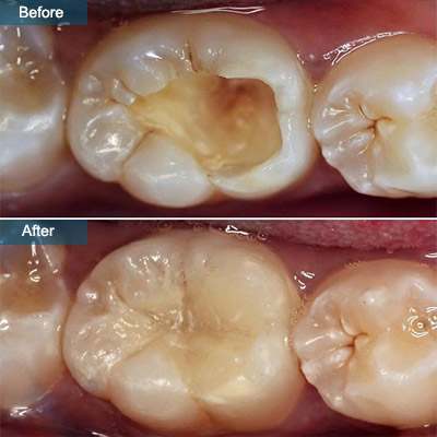 Why You Need To Get A Hole In Tooth Fixed