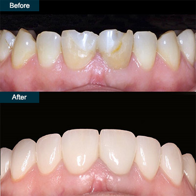 What is Cosmetic Dental Bonding and How Much Does it Cost?