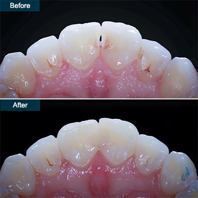 Resin bonding increases tooth length for short teeth