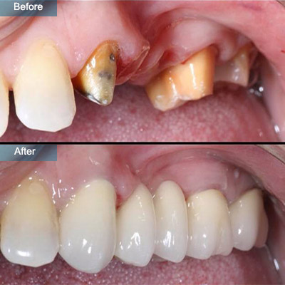 Before & After - Top Rated Family & Cosmetic Dentist in Brooklyn NY