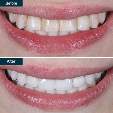 laser teeth whitening brooklyn