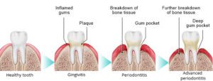 Gum Disease (Receding Gums, Abscess, Infection) Treatment in Brooklyn