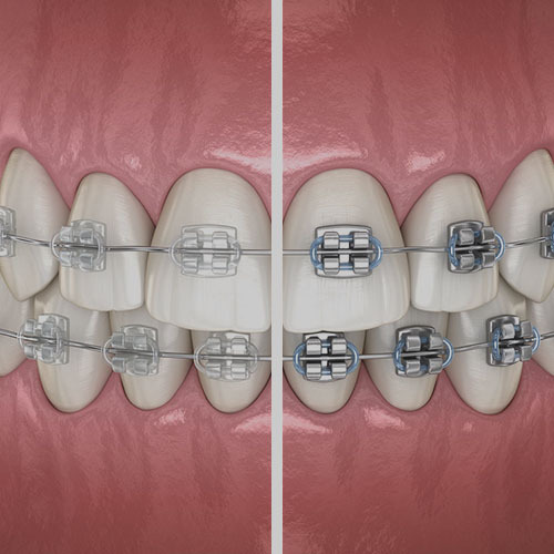 invisible aligners  INE Dental Practice